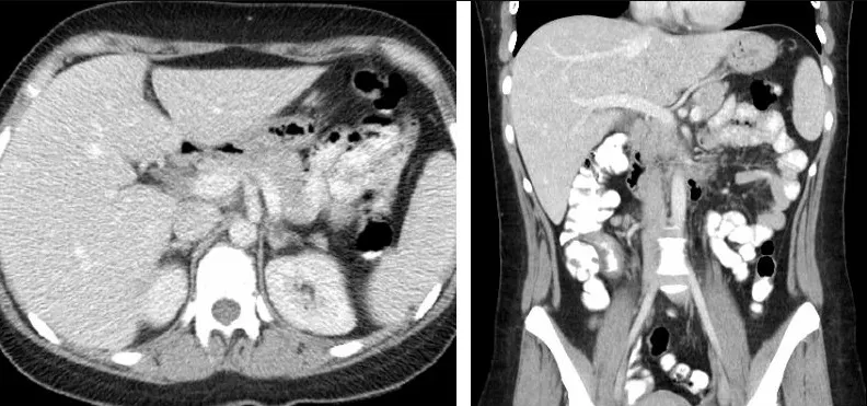 Adrenal Incidentaloma: What a Nodule on Your Adrenal Gland Means