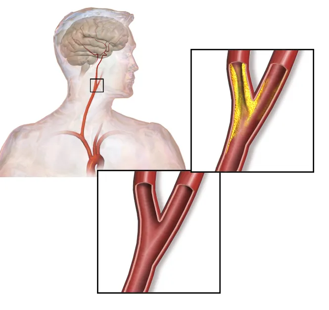 Atherosclerotic Plaque: What It Means on a Scan, Causes, and How It's Managed
