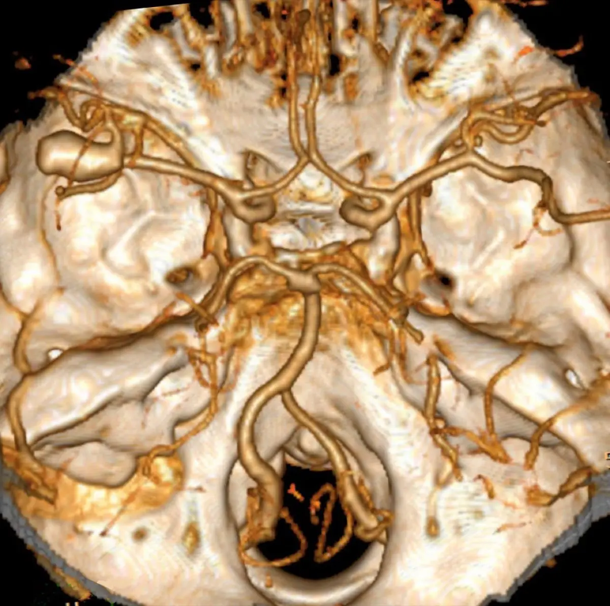 Brain Aneurysm on a Scan: What It Means, When It's Serious, and How It's Treated