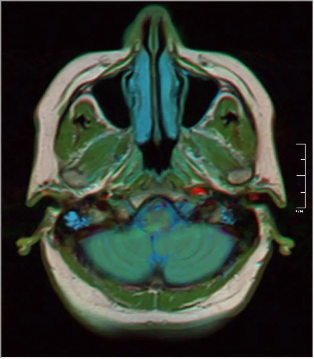 Seizures and Brain Tumors in Dogs: What an MRI Can Show