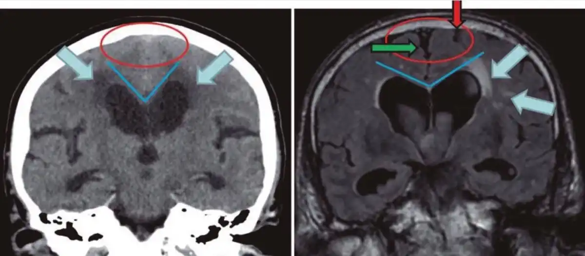 Cerebral Atrophy on MRI: What It Means, Causes, and When to Worry