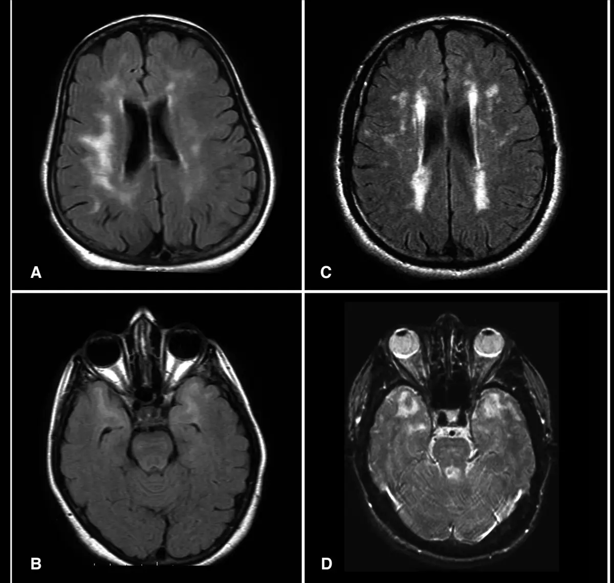 Chronic Ischemic Changes on MRI: What They Mean, Causes, and Next Steps