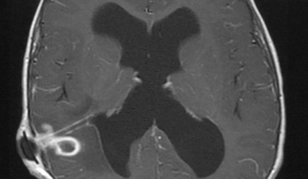 What Does "Contrast Enhancement" Mean in a Radiology Report?