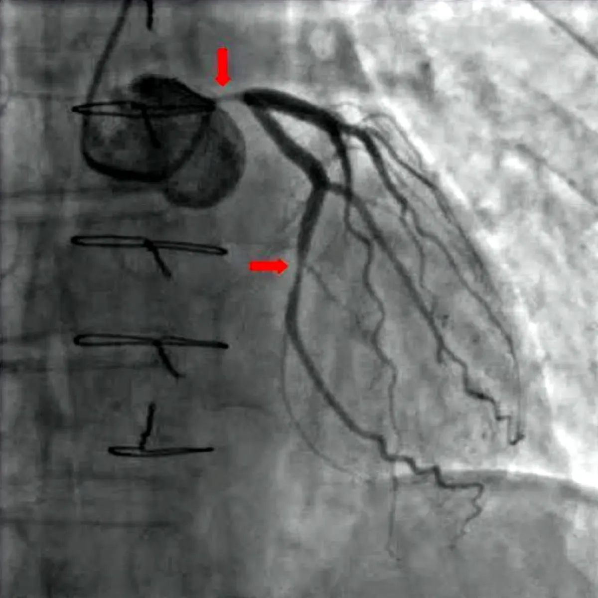 Coronary Artery Calcium Score: What Your CAC Number Means for Heart Risk