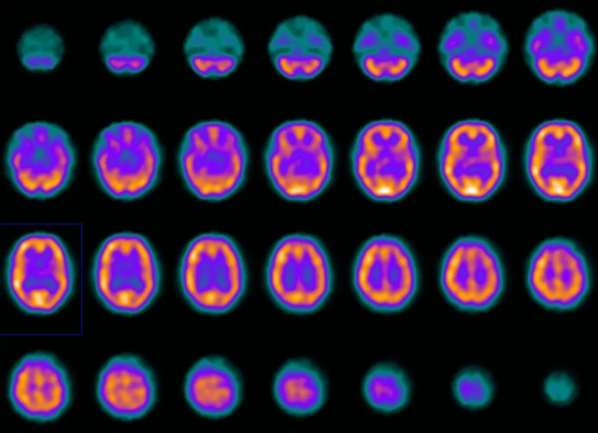 DaTscan for Parkinson's: What the Result Means and What It Cannot Say