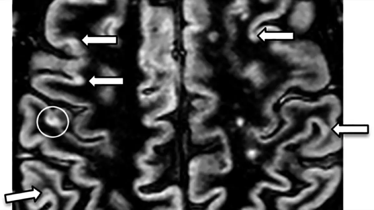 Demyelinating Plaques on MRI: What They Mean, Causes, and Next Steps