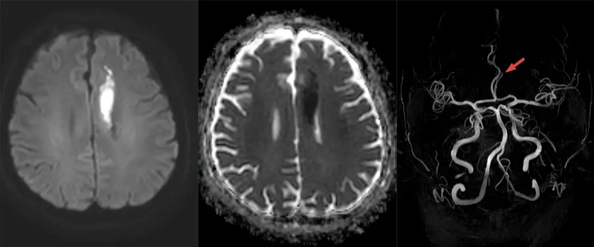 What Does "Diffusion Restriction" Mean in a Radiology Report?