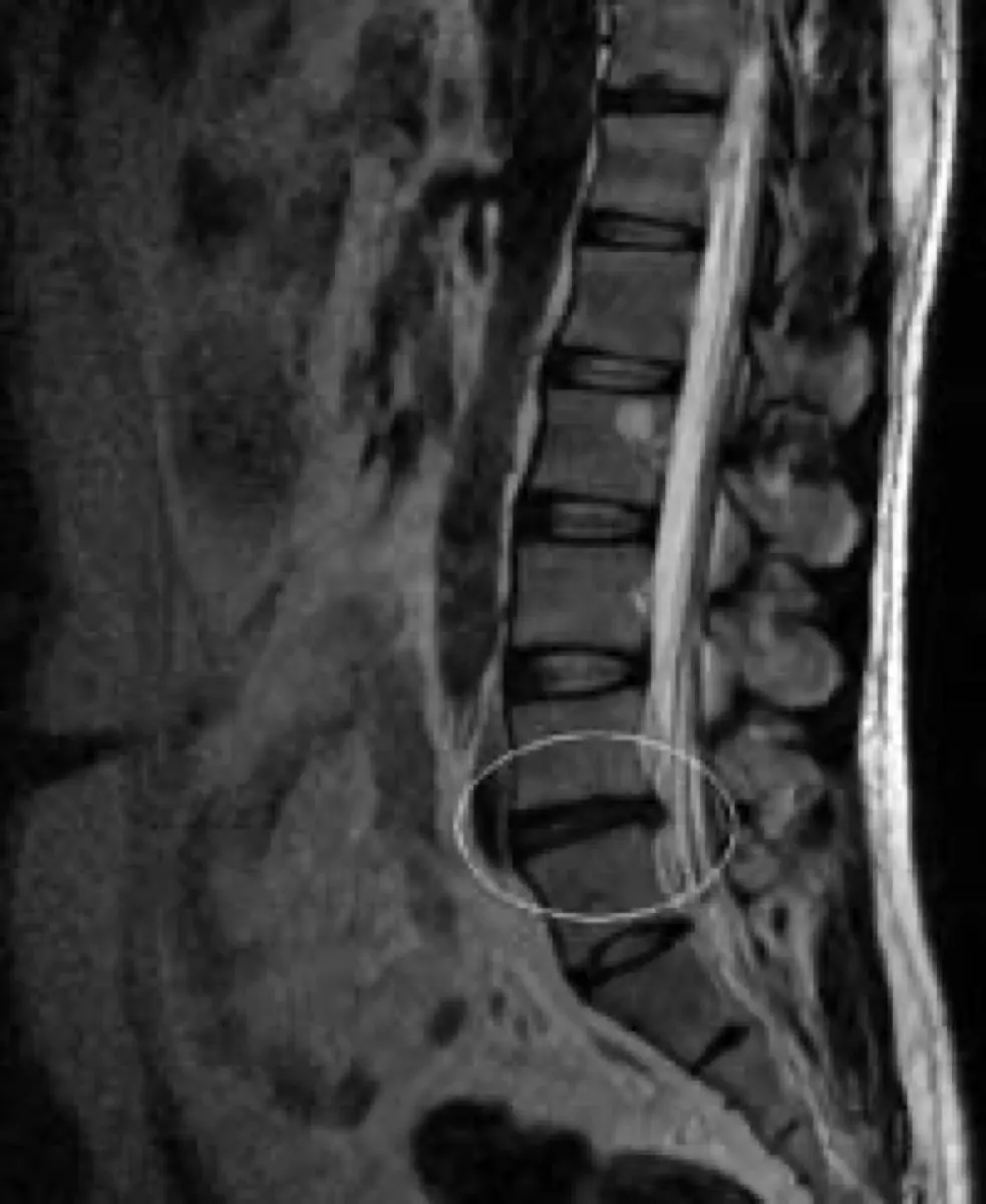 Disc Herniation on MRI: Causes, Symptoms, and Treatment Options