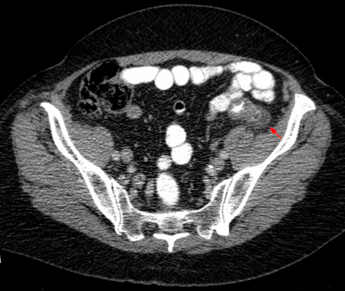 What Does "Fat Stranding" Mean in a Radiology Report?