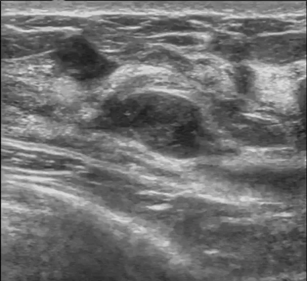 Fibroadenoma on Breast Ultrasound: What It Means, Causes, and When to Worry