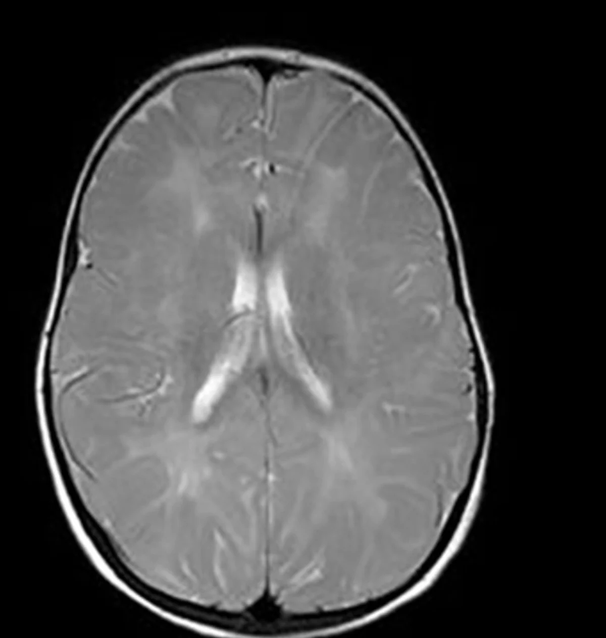 Gliotic Changes on MRI: What They Mean, Causes, and When to Worry