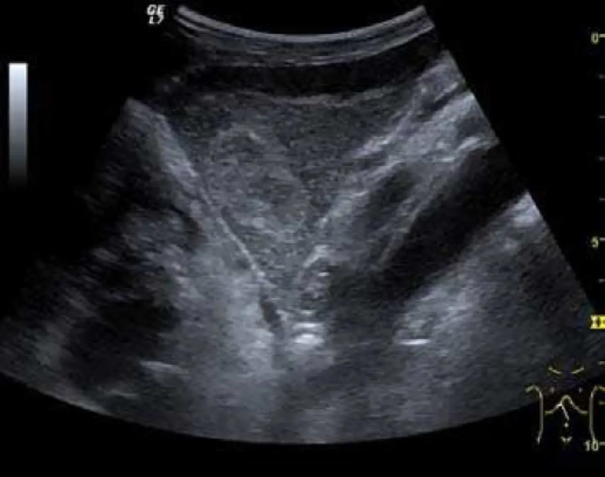 Hepatic Hemangioma: What It Means, Common Causes, and When to Worry