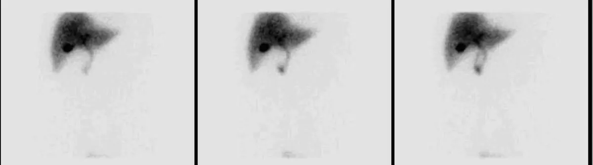 HIDA Scan: What a Gallbladder Scan Shows and What the Ejection Fraction Means