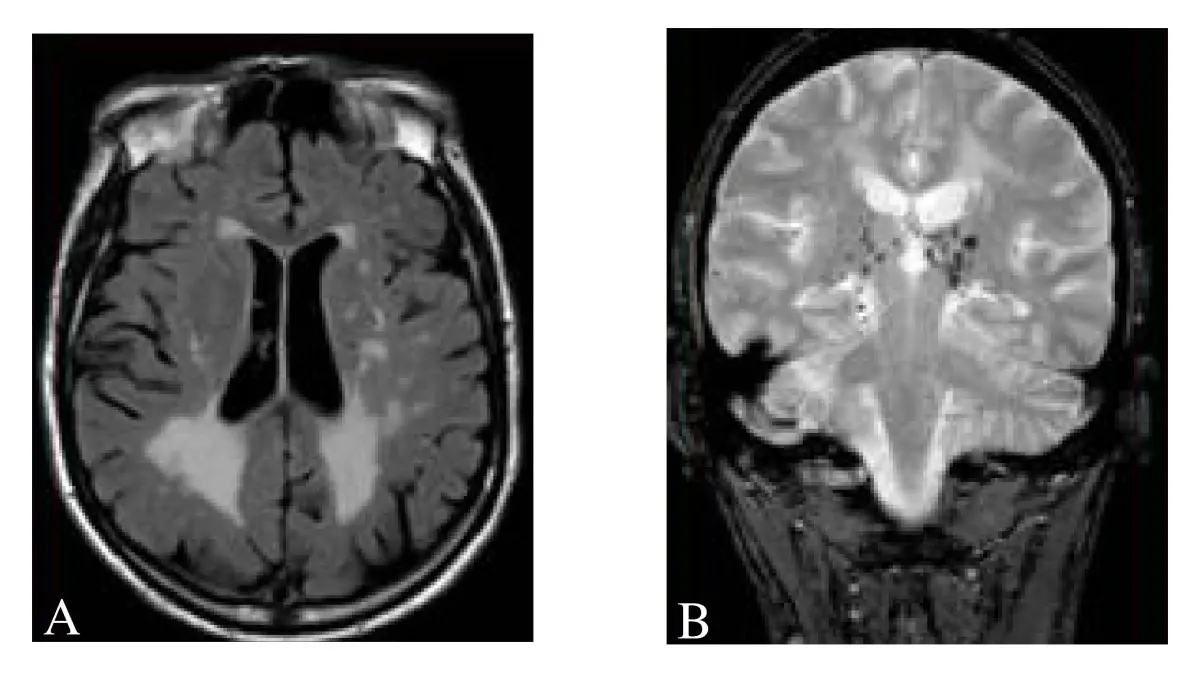 Lacunar Infarct on MRI: What It Means, Causes, and When to Worry