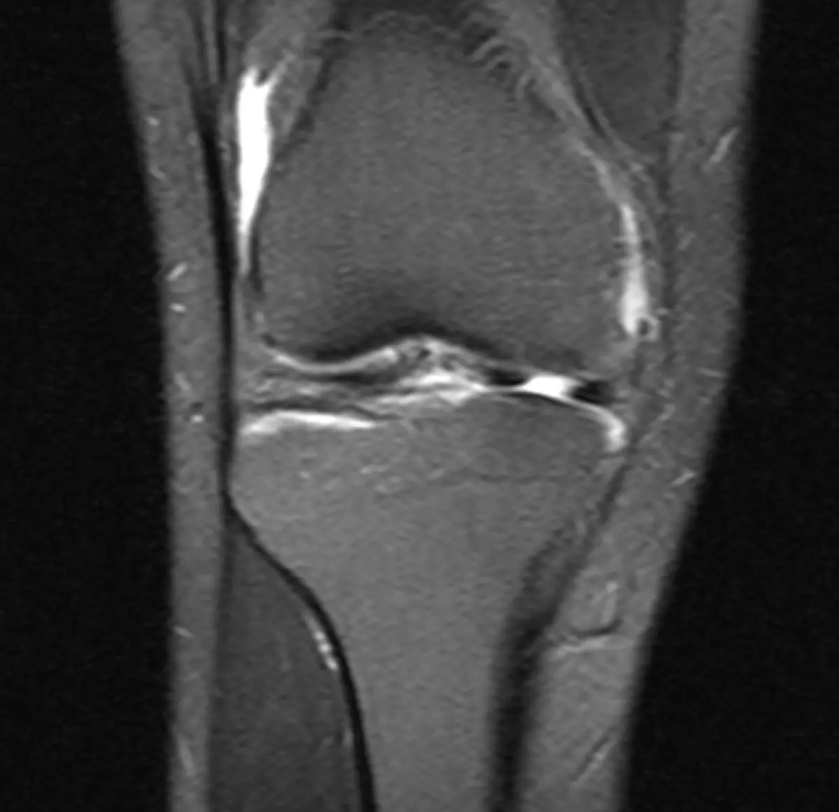 Meniscal Tear on MRI: What It Means, Causes, and Treatment Options