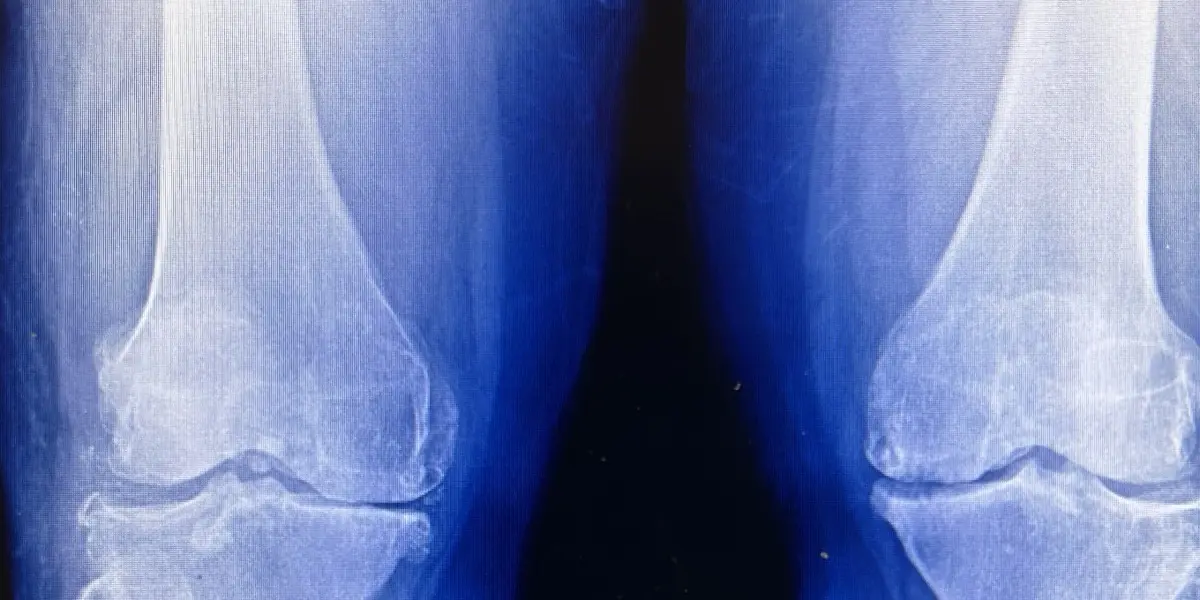 Osteoarthritis on X-ray and MRI: What Joint-Space Narrowing Really Means