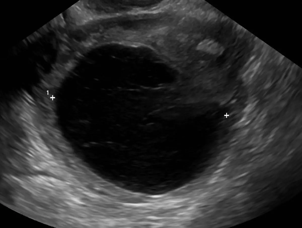 Ovarian Cyst on Ultrasound: What It Means, Causes, and When to Worry
