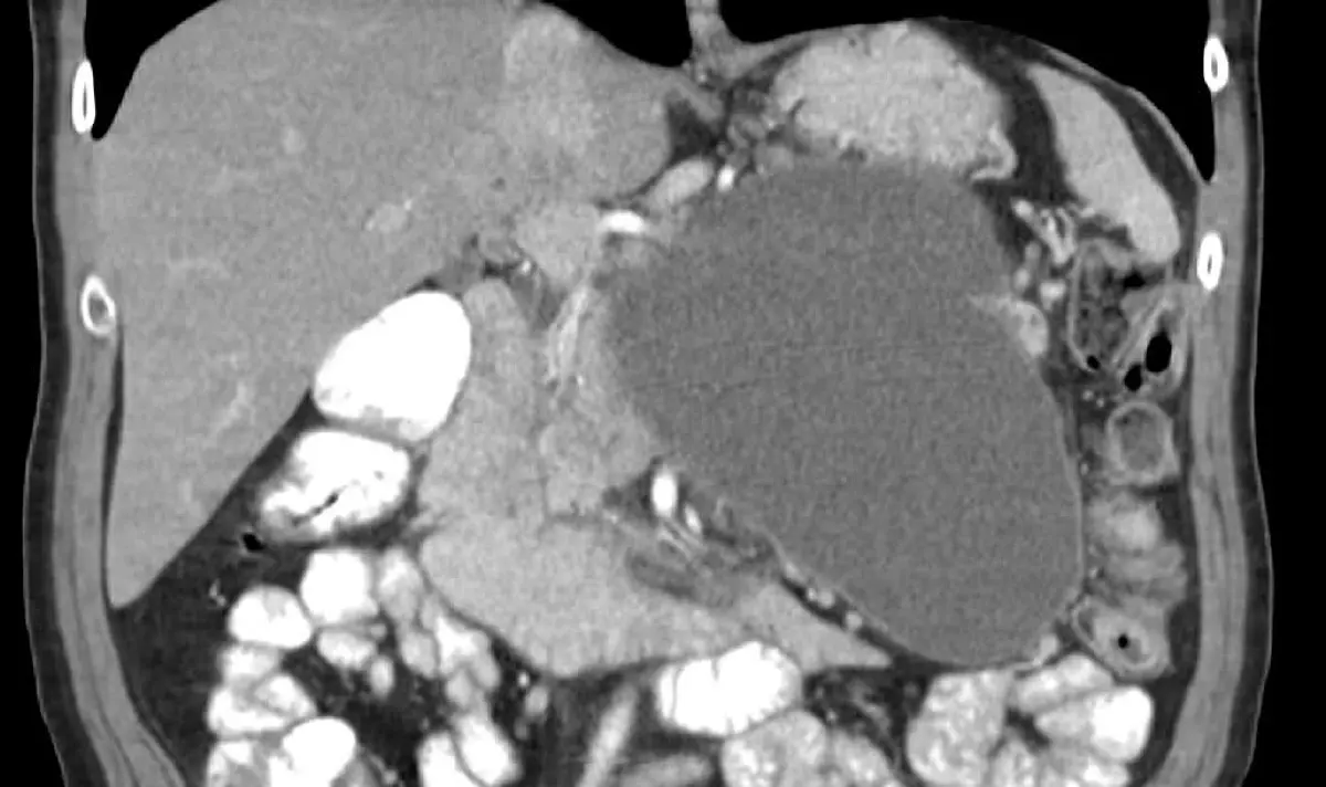 Pancreatic Cyst on MRI or CT: What It Means and When to Worry
