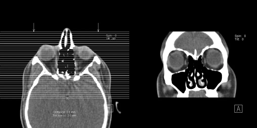 Paranasal Sinus Mucosal Thickening: What It Means and When to Worry
