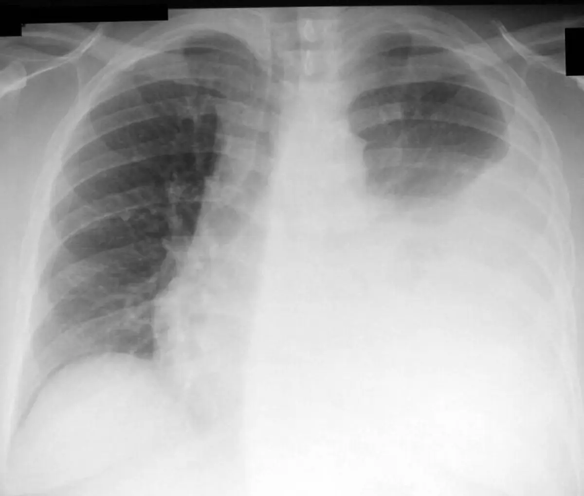 Pleural Effusion: What Fluid Around the Lung Means, Causes, and Treatment
