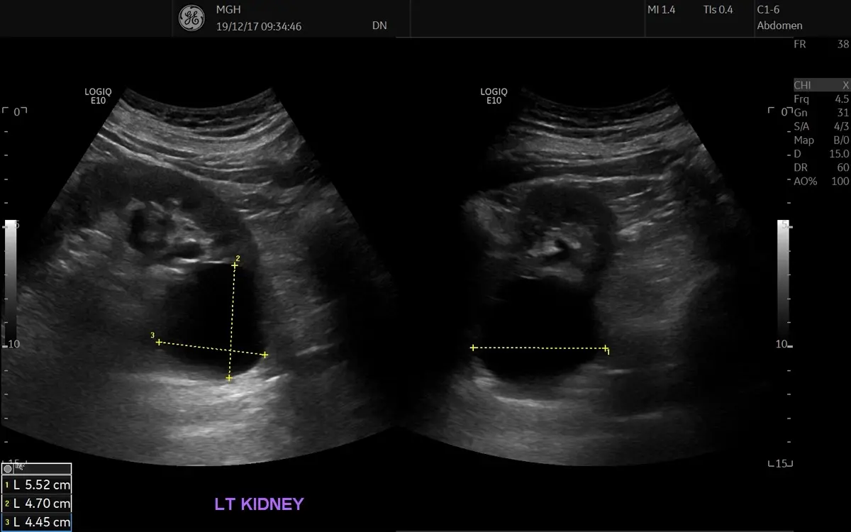 Renal Cyst: What It Means on Ultrasound and CT, Causes, and When to Worry