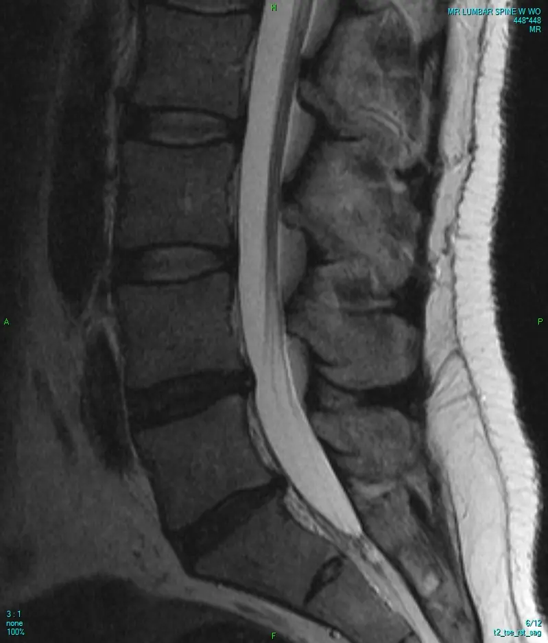 Spine MRI Second Opinion: Lumbar, Cervical and Thoracic