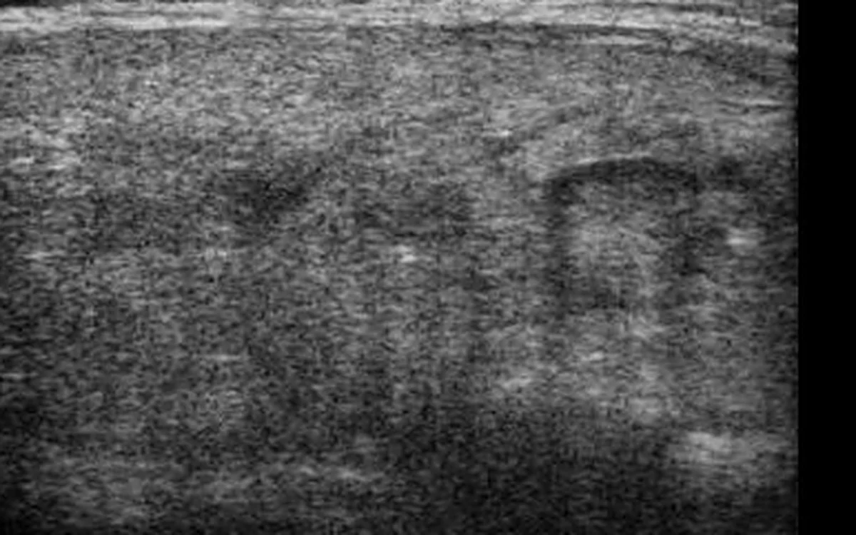 Thyroid Nodule on Ultrasound: What It Means, Causes, and When to Worry