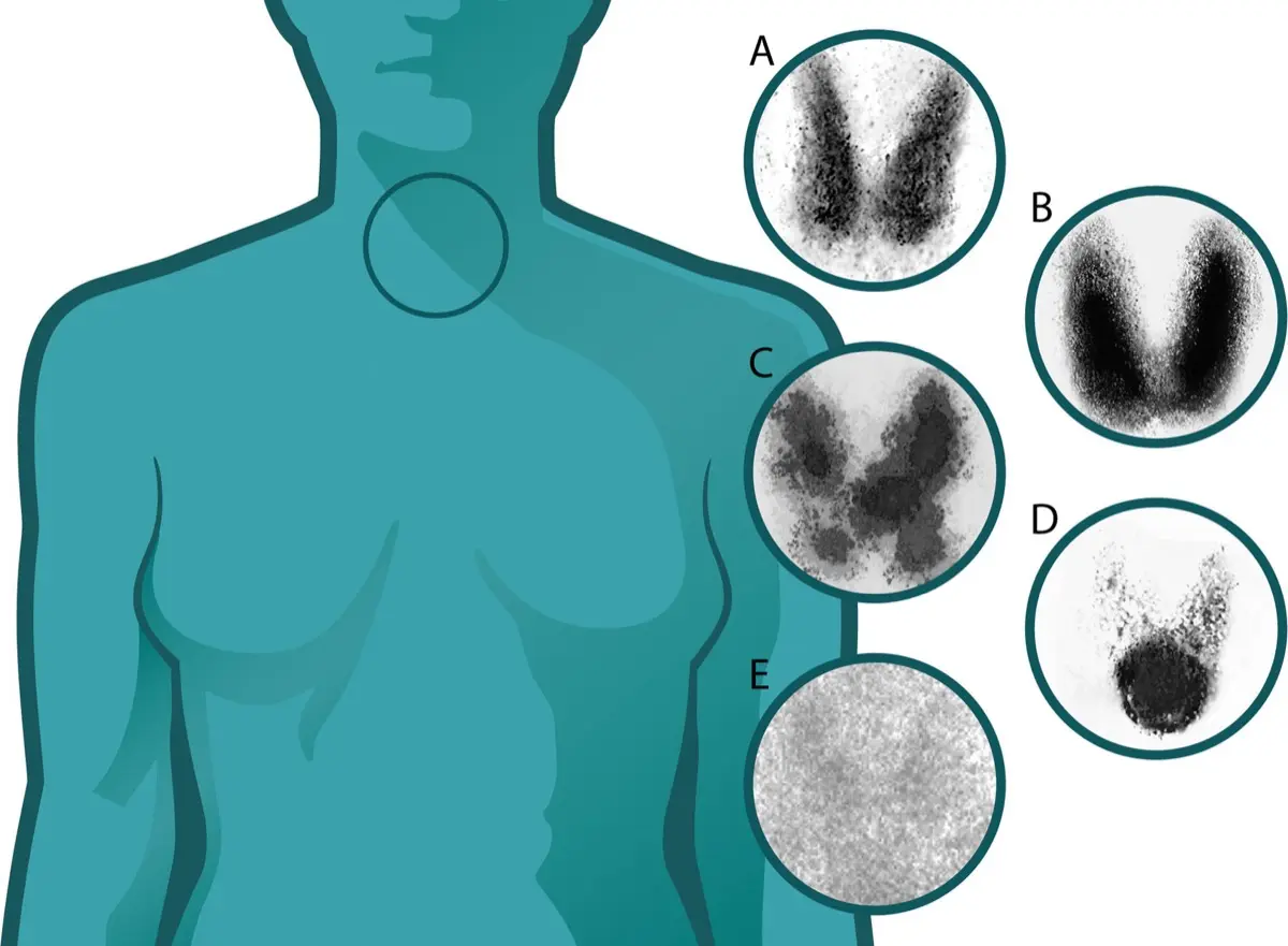 Thyroid Uptake Scan: What Hot and Cold Nodules Mean