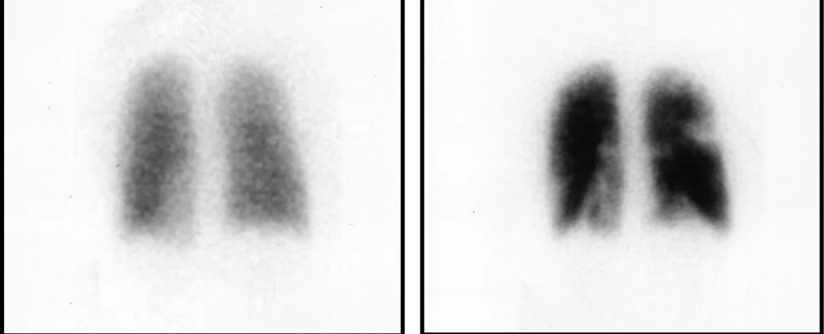 V/Q Scan: What a Ventilation-Perfusion Lung Scintigraphy Shows